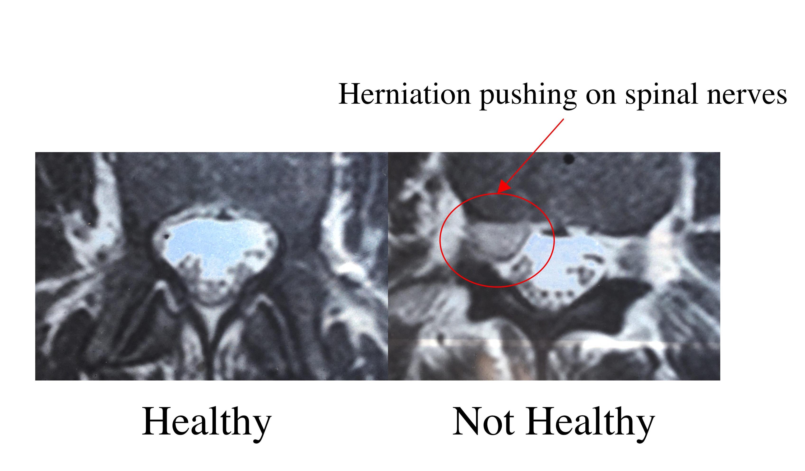 Grade 1 retrolisthesis l5