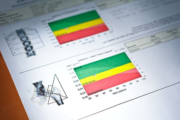 scoring bone density after a dexa scan